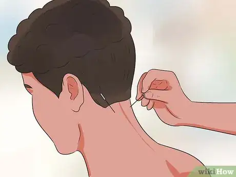 Step 5 尝试针灸疗法。