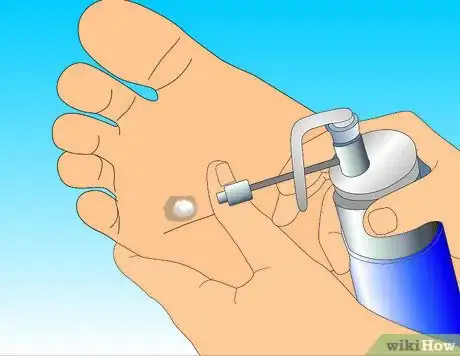 Get Rid of a Wart at the Bottom of Your Foot Step 3.jpeg