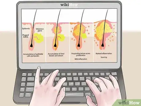 Step 2 毛囊受损可能引发皮脂囊肿。