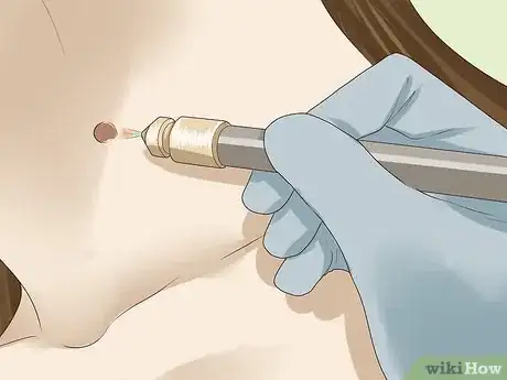 Step 4 让医生烧灼皮赘。