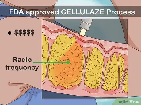 Step 3 到医疗级水疗中心进行Cellulaze激光去脂。