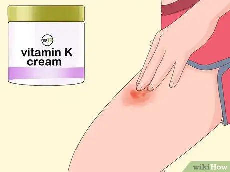 Step 6 在患处涂抹维生素K乳霜。