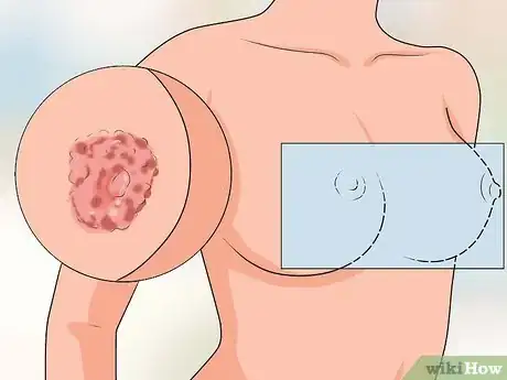 Step 3 识别乳房湿疹。