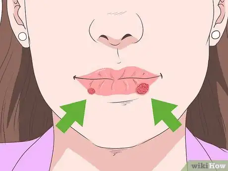 Step 1 确认你患的是唇疱疹。
