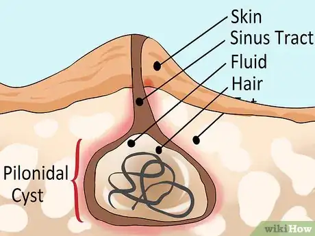 Step 1 了解什么是藏毛囊肿。