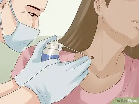 Step 3 让医生冷冻皮赘。