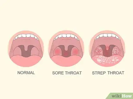 Step 1 判断喉咙痛的严重度。