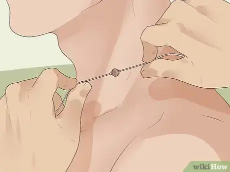 Step 3 结扎皮赘。