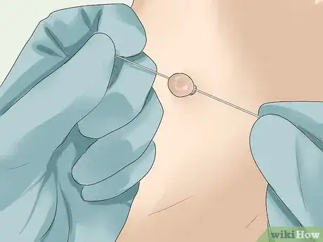 Step 5 让医生切断皮赘的血液供给。