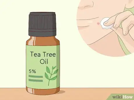 Step 3 用茶树油自然对抗白头粉刺。