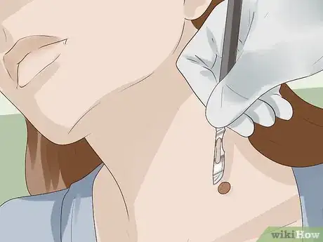 Step 2 让医生切除皮赘。
