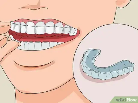 Step 2 购买牙科夹板。
