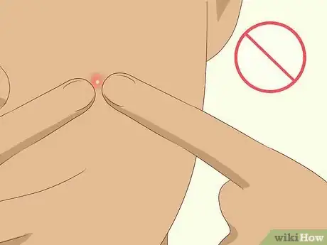 Step 5 不要挑或挤白头粉刺。