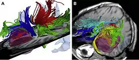 Intraoperative colocalization using iMRI images and 3-D Slicer software.