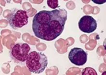 Acute erythroid leukemia, a rare form of acute myeloid leukemia