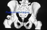 Posterior wall fracture as seen on 3-D CT scan