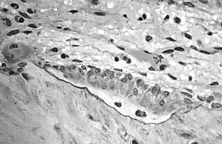 Light micrograph of decalcified cancellous bone displaying osteoblasts forming new bone tissue, containing two osteocytes, within a resorption pit.