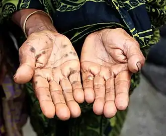 Signs of arsenic poisoning include changes in skin pigmentation. This person experienced As poisoning due to contaminated water.