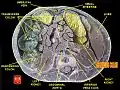 Ascending colon