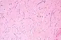 Atrial myxoma. H&E stain.