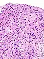 Histopathology of urothelial carcinoma of the urinary bladder, showing a nested pattern of invasion. Transurethral biopsy. H&E stain