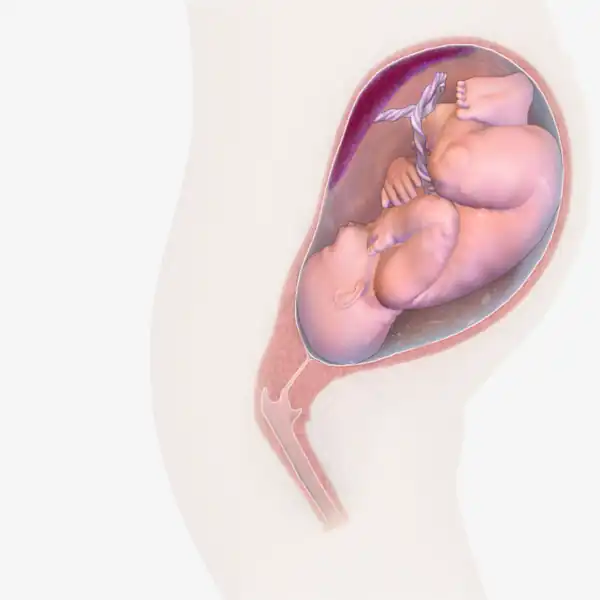 The diagram is titled Possible effects of nicotine on the developing fetal brain. The text states: Vaping during pregnancy is not safe for the growing fetal brain. Nicotine binds to nicotinic acetylcholine receptors Dysregulation of catecholaminergic neurotransmitter system Dysregulation of serotonergic neurotransmitter system Dysregulation of other neurotransmitter systems Changes to the corpus callosum Changes in brain metabolism Changes in neurotransmitter systems Changes in normal brain development Stillbirth Sudden infant death syndrome Auditory processing complications Developmental disturbances Behavioral abnormalities in adults and children Lower birth weights compared to other infants Reduction in brain weight The caption states: Nicotine exposure during pregnancy can harm fetal brain development.