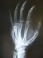 Fracture of the fifth metacarpal (boxer's fracture).