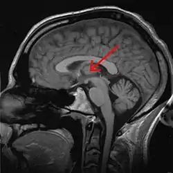 360 rotation of Thalamus