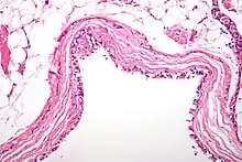 Histological micrographic image of a bronchogenic cyst of the mediastinum. Sample has been stained with hematoxylin and eosin to improve contrast.