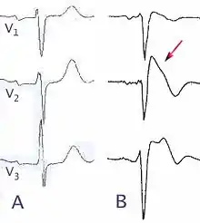 Normal electrocardiograms compared to electrocardiograms of people with Brugada Syndrome