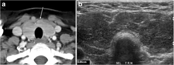 Fig. 15. A 33-year-old female patient who presented with neck swelling and pain and was later diagnosed with Hashimoto's thyroiditis. an Axial enhanced CT scan of the neck demonstrates minimal diffuse enlargement of the thyroid gland, especially the isthmus (white arrow). b Transverse greyscale ultrasound of the neck demonstrates heterogeneously enlarged thyroid and thickened isthmus, measuring 8.6 mm.