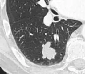 Lobulated nodule.