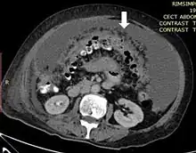 medical image showing thickened greater omentum