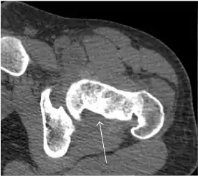 Axial CT image of pigmented villonodular synovitis eroding the posterior cortex of the femoral neck.