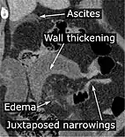 CT scan of a small bowel volvulus. It shows two juxtaposed segments of narrowing, which is the spot of mesentery rotation. The other signs indicate strangulation.