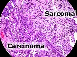 Carcinosarcoma