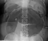 Plain X ray of a cecal volvulus