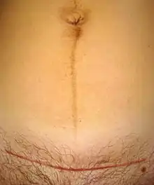 A Cesarean section scar (horizontal red line) and linea nigra visible on a 31-year-old woman seven weeks after childbirth.