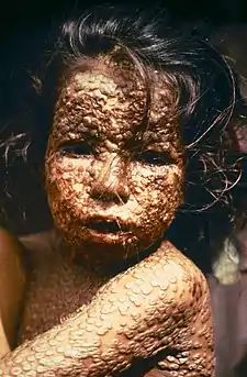 Child with Smallpox, Bangladesh, 1973, the year Geddes was assigned to the WHO smallpox eradication effort in Bangladesh