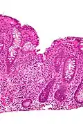 Focal cryptitis and a granuloma. H&E stain.