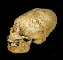 Proto Nazca deformed skull, c. 200–100 BCE