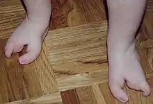 Oligodactyly, 2 toes on the feet of a one-year-old child