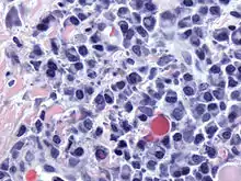 Atypical plasma cell infiltrate with both Russell (cytoplasmic) and Dutcher (nuclear) bodies (H&E, 50x)