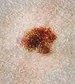 Atypical nevus