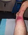 Early symptoms of necrotizing fasciitis. The darker red center is going black.