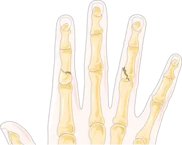 On the index finger, a fracture of the shaft that does not affect the joint. On the right, a fracture affecting the ring finger's proximal interphalangeal joint, or PIP joint