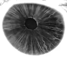 Fluorescein angiograpy of the iris reveals a radial layout of blood vessels.