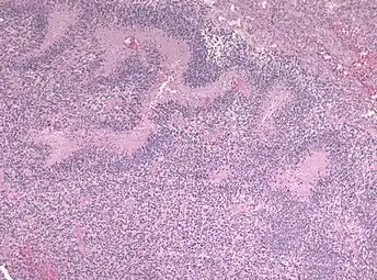 Pseudopalisades seen around necroses in glioblastoma.