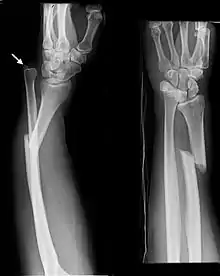 Galeazzi facture (displaced fracture of the radius)