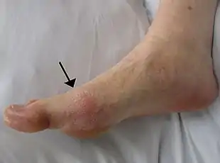 side view of a foot showing a red patch of skin over the joint at the base of the big toe